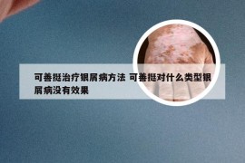 可善挺治疗银屑病方法 可善挺对什么类型银屑病没有效果