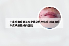 牛皮癣治疗要花多少钱之杭州杭城 浙江治疗牛皮病癣最好的医院