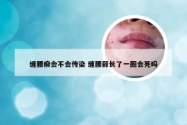 缠腰癣会不会传染 缠腰藓长了一圈会死吗