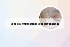 张仲景治疗银屑病偏方 张仲景皮肤病药方