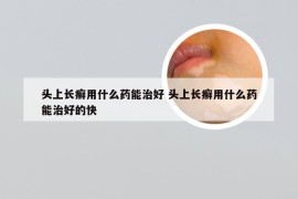 头上长癣用什么药能治好 头上长癣用什么药能治好的快