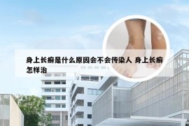 身上长癣是什么原因会不会传染人 身上长癣怎样治