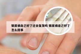 银屑病自己好了还会复发吗 银屑病自己好了怎么回事