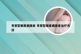 寻常型银屑病激素 寻常型银屑病激素治疗方法