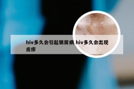 hiv多久会引起银屑病 hiv多久会出现皮疹