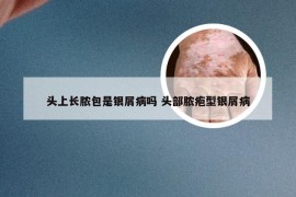 头上长脓包是银屑病吗 头部脓疱型银屑病