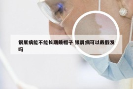 银屑病能不能长期戴帽子 银屑病可以戴假发吗