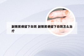 副银屑病留下白斑 副银屑病留下白斑怎么治疗