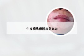 牛皮癣头痒脱皮怎么办