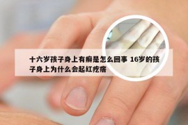 十六岁孩子身上有癣是怎么回事 16岁的孩子身上为什么会起红疙瘩