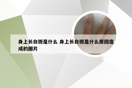 身上长白斑是什么 身上长白斑是什么原因造成的图片