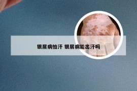 银屑病怕汗 银屑病能出汗吗