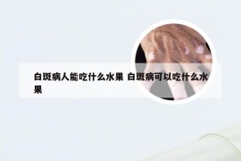 白斑病人能吃什么水果 白斑病可以吃什么水果