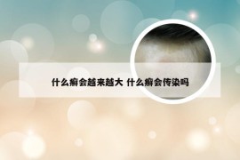 什么癣会越来越大 什么癣会传染吗