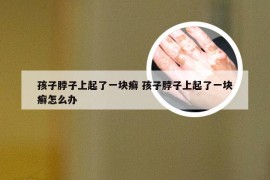 孩子脖子上起了一块癣 孩子脖子上起了一块癣怎么办