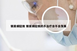 银屑病轻微 银屑病轻微的不治疗会不会发展