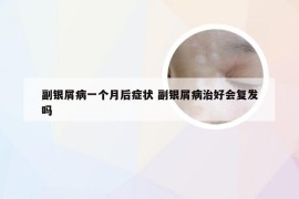 副银屑病一个月后症状 副银屑病治好会复发吗