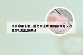 牛皮癣用卡泊三醇之后流水 银屑病涂完卡泊三醇以后比原来红