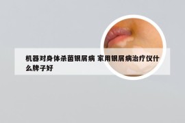 机器对身体杀菌银屑病 家用银屑病治疗仪什么牌子好