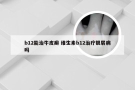 b12能治牛皮癣 维生素b12治疗银屑病吗