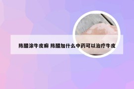 陈醋涂牛皮癣 陈醋加什么中药可以治疗牛皮