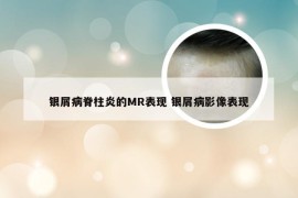 银屑病脊柱炎的MR表现 银屑病影像表现