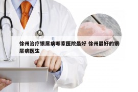 徐州治疗银屑病哪家医院最好 徐州最好的银屑病医生