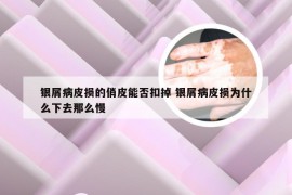 银屑病皮损的俏皮能否扣掉 银屑病皮损为什么下去那么慢