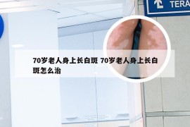 70岁老人身上长白斑 70岁老人身上长白斑怎么治