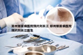 郑州银屑病医院预约刘长江 郑州银屑病医院预约刘长江医生