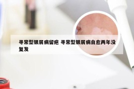 寻常型银屑病留疤 寻常型银屑病自愈两年没复发