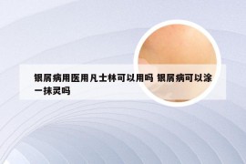 银屑病用医用凡士林可以用吗 银屑病可以涂一抹灵吗