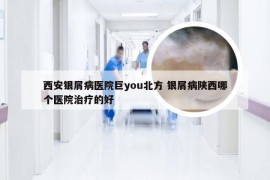 西安银屑病医院巨you北方 银屑病陕西哪个医院治疗的好