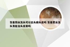 生姜熬水洗头可以去头癣头皮吗 生姜煮水洗头发能治头皮屑吗