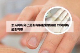 怎么判断自己是否有脓疱型银屑病 如何判断是否有脓