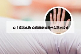 白瘨疯怎么治 白疯癫症状用什么药比较好