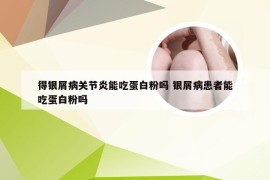 得银屑病关节炎能吃蛋白粉吗 银屑病患者能吃蛋白粉吗