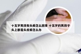 十五岁男孩有头癣怎么回事 十五岁的男孩子头上都是头皮癣怎么办