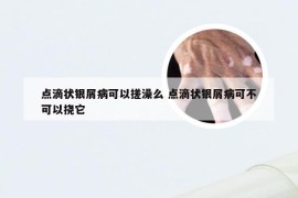 点滴状银屑病可以搓澡么 点滴状银屑病可不可以挠它