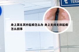 身上莫名其妙起癣怎么办 身上无缘无故起癣怎么回事