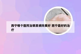 西宁哪个医院治银屑病效果好 西宁最好的治疗