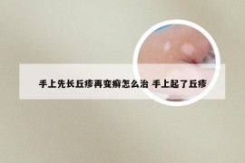 手上先长丘疹再变癣怎么治 手上起了丘疹