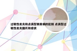 过敏性皮炎和点滴型银屑病的区别 点滴型过敏性皮炎图片和症状