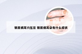 银屑病耳穴压豆 银屑病耳朵有什么症状