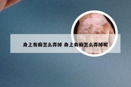 身上有癣怎么弄掉 身上有癣怎么弄掉呢