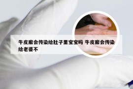 牛皮廨会传染给肚子里宝宝吗 牛皮廨会传染给老婆不