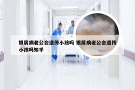 银屑病老公会遗传小孩吗 银屑病老公会遗传小孩吗知乎