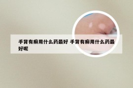 手背有癣用什么药最好 手背有癣用什么药最好呢