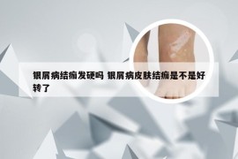 银屑病结痂发硬吗 银屑病皮肤结痂是不是好转了