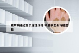 银屑病通过什么途径传播 银屑病怎么传播途径